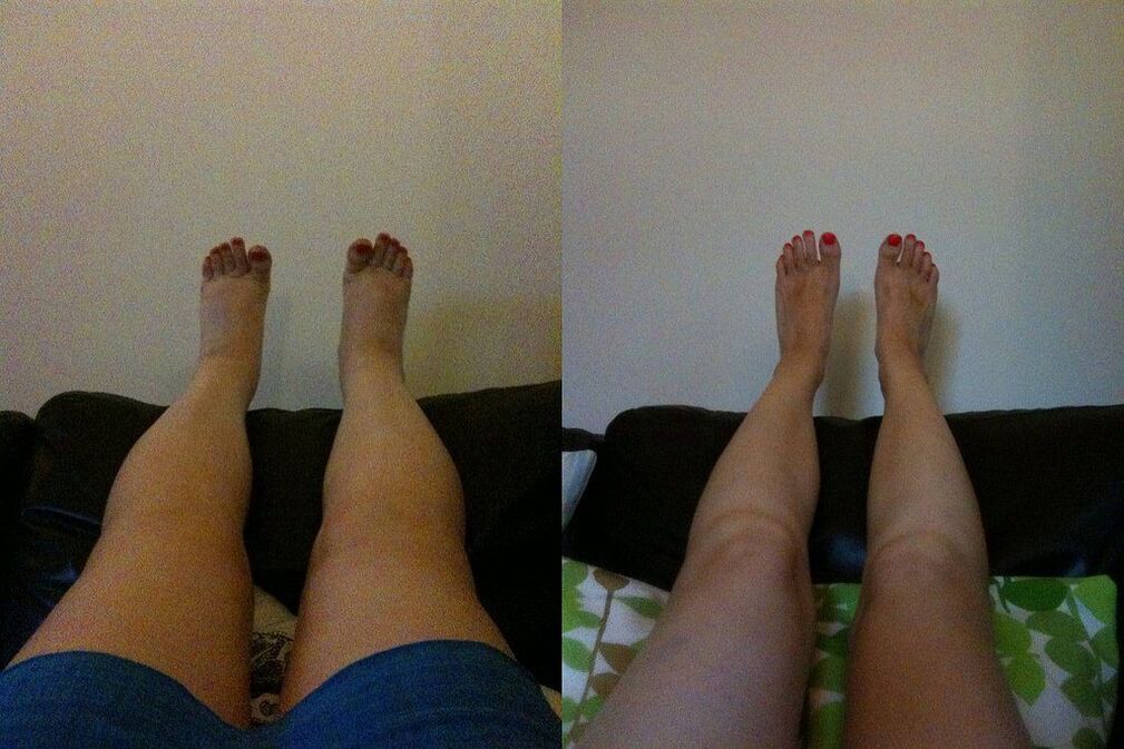 Effective results before and after using Ostelife Premium Plus cream from Margarita