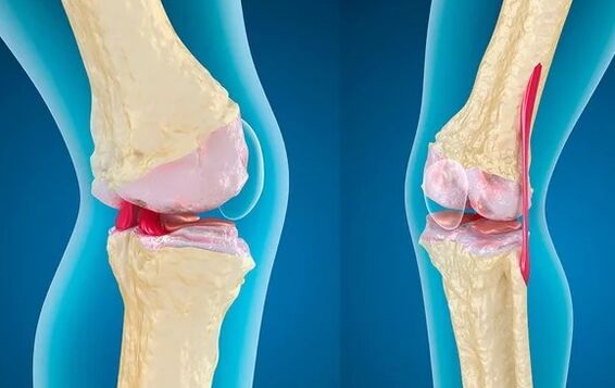 Gonarthrosis from the 3rd stage of the knee joint