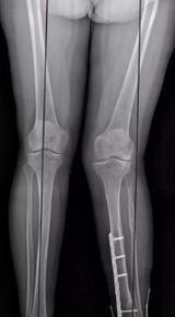 Knee deformation