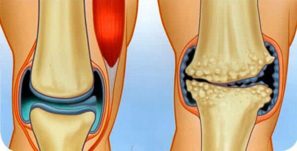 Common conditions of joints and causes of development of knee arthrosis