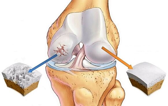 norms and deviations for knee joint arthrosis