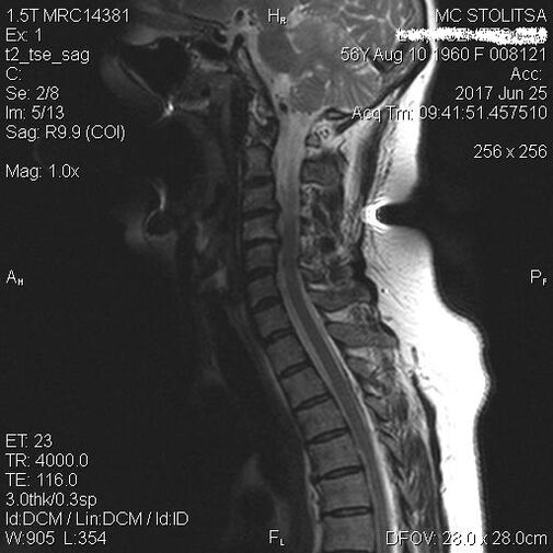 Osteochondrosis and cervical spondylosis spondylosis