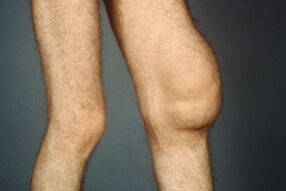 Causes and symptoms of knee joint arthrosis