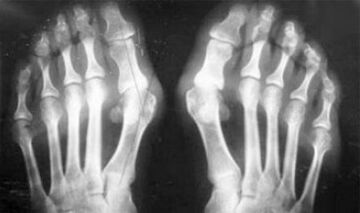 Diagnosis of differential symptoms of arthritis and arthrosis