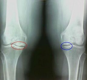 Results of the treatment of arthritis and people's remedic arthrosis