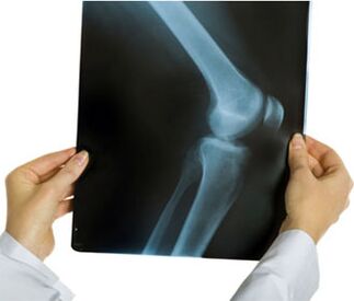 X-ray arthrosis of the knee joint