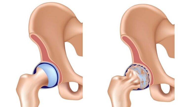 Healthy and together with arthrosis