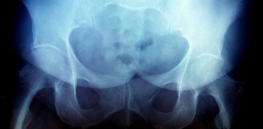 X -ray picture with degree arthrosis -2